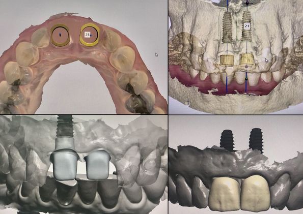 Navigovaná chirurgia v našej praxi – súčasná digitálna stomatológia
