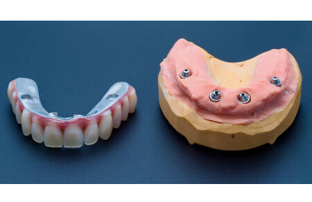 01_Titánový strmeň a kompozitné zuby