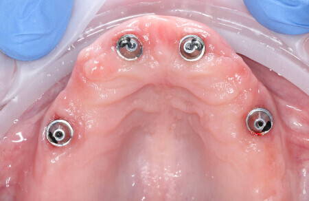 02_Titanovy strmen a kompozitne zuby