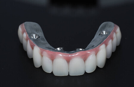 03_Titanovy strmen a kompozitne zuby