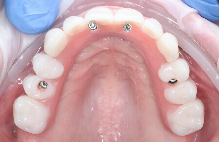 04_Titanovy strmen a kompozitne zuby