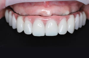 05_Titanovy strmen a kompozitne zuby