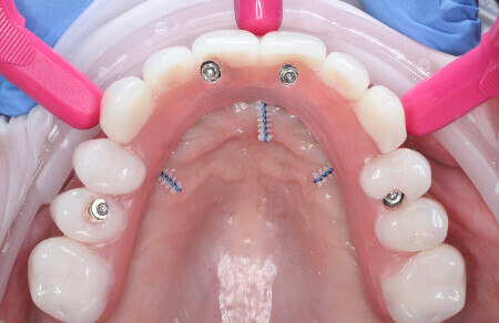 06_Titanovy strmen a kompozitne zuby