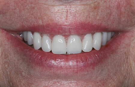 07_Titanovy strmen a kompozitne zuby