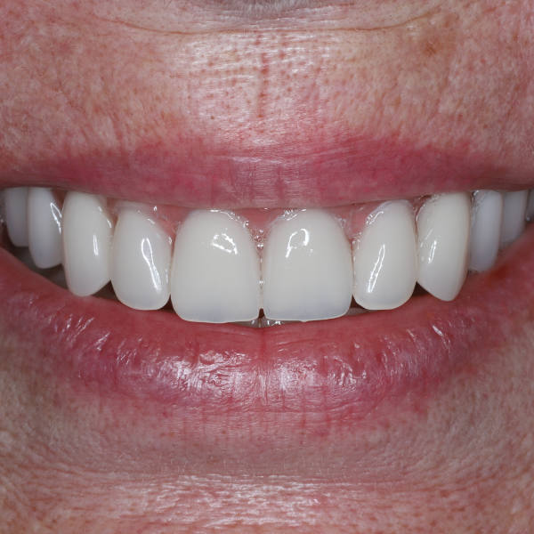 All on 4: titanová priečka a kompozitné zuby