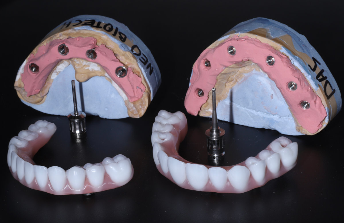 01_All on 4/6/8 frézovaná titánová priečka, kompozitné zuby