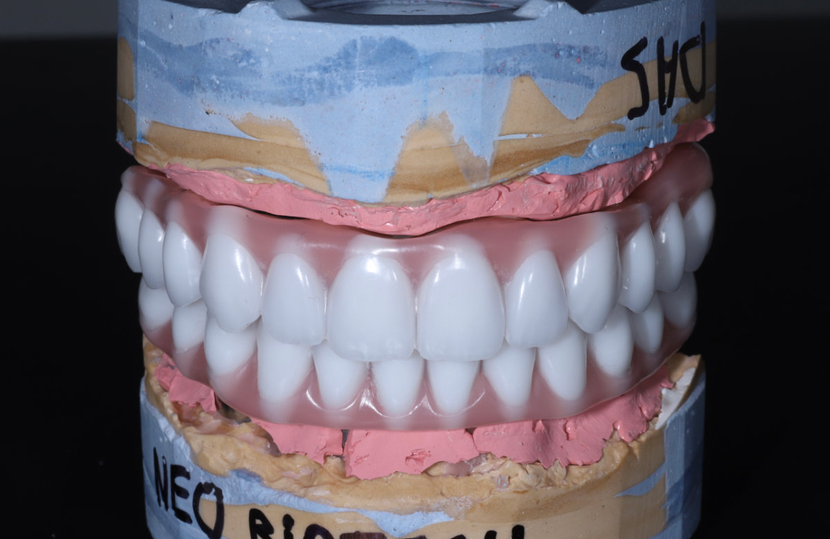 02_All on 4/6/8 frézovaná titánová priečka, kompozitné zuby