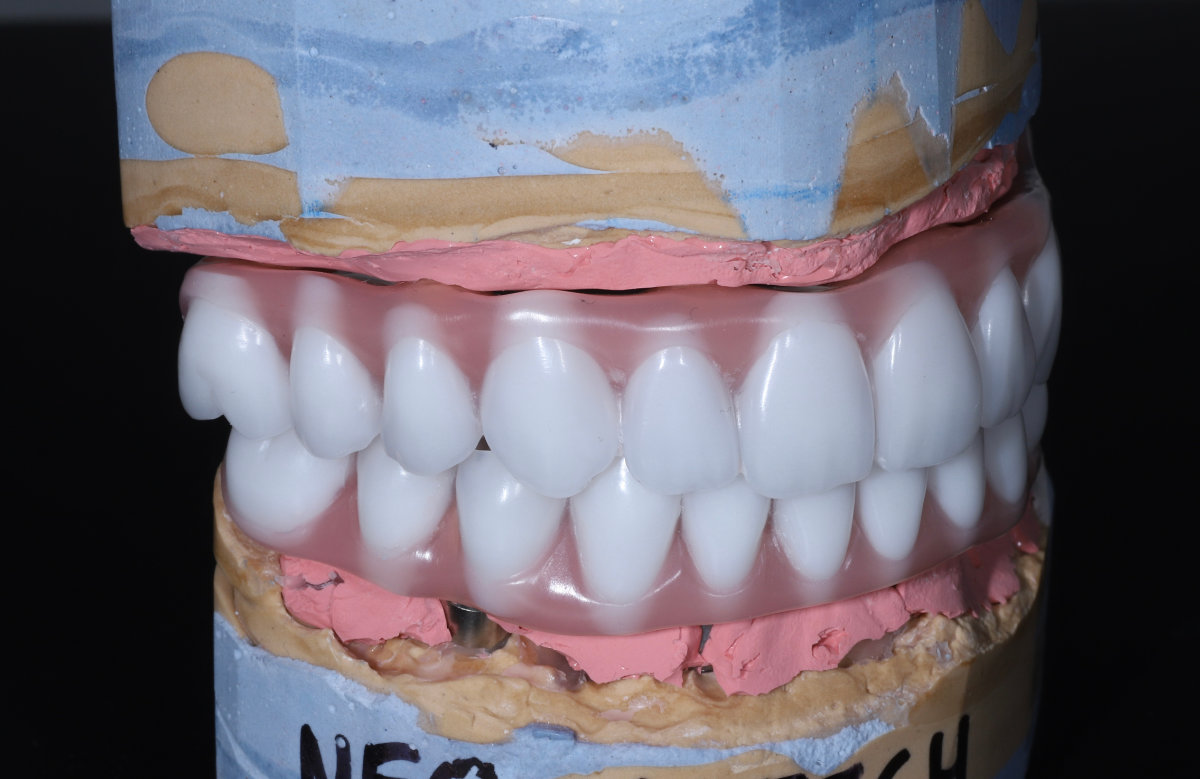 All on 4/6/8 frézovaná titánová priečka, kompozitné zuby, živicová čast' gingivy