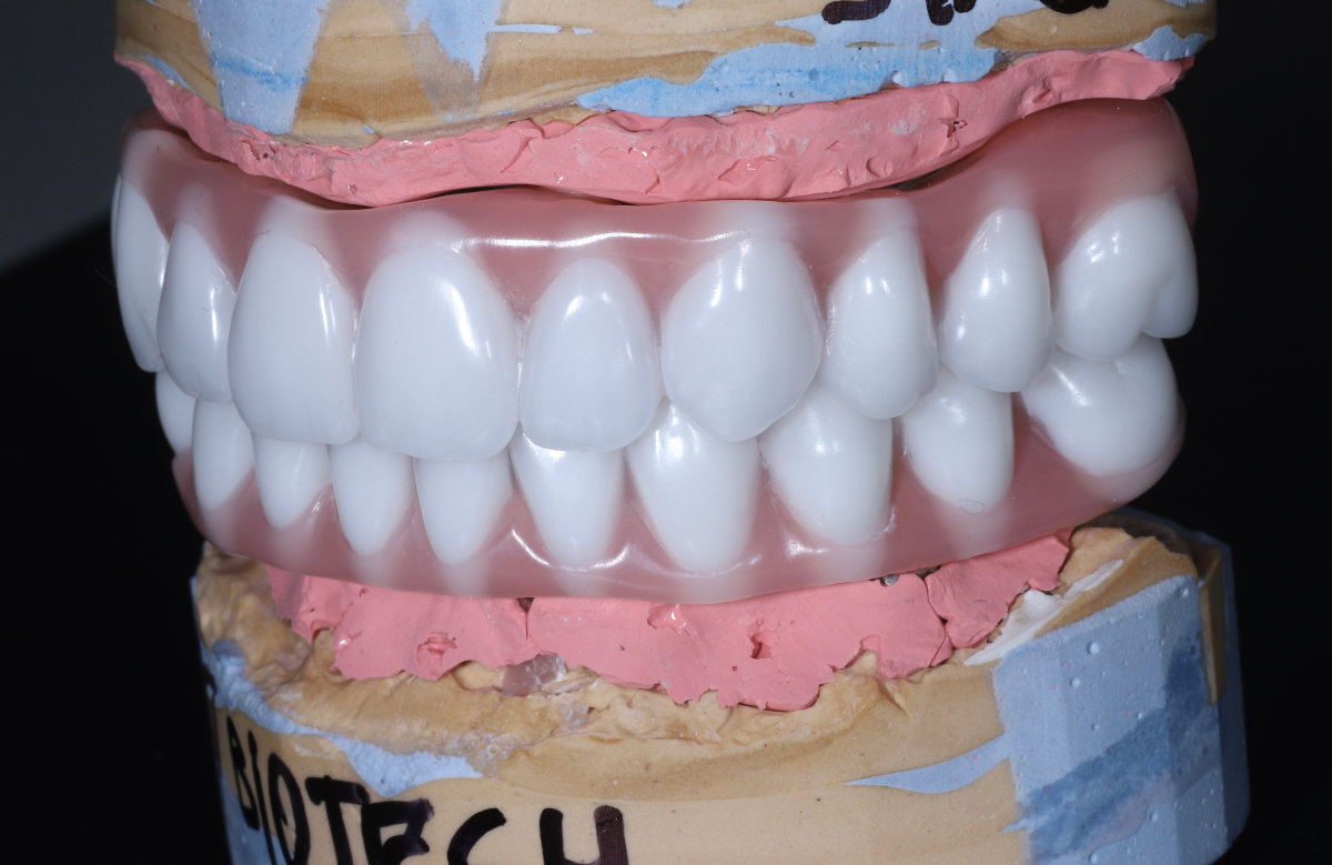 04_All on 4/6/8 frézovaná titánová priečka, kompozitné zuby