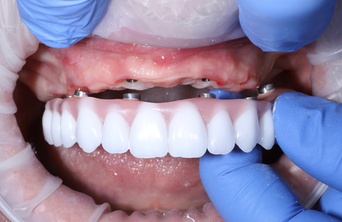 05_All on 4/6/8 frézovaná titánová priečka, kompozitné zuby