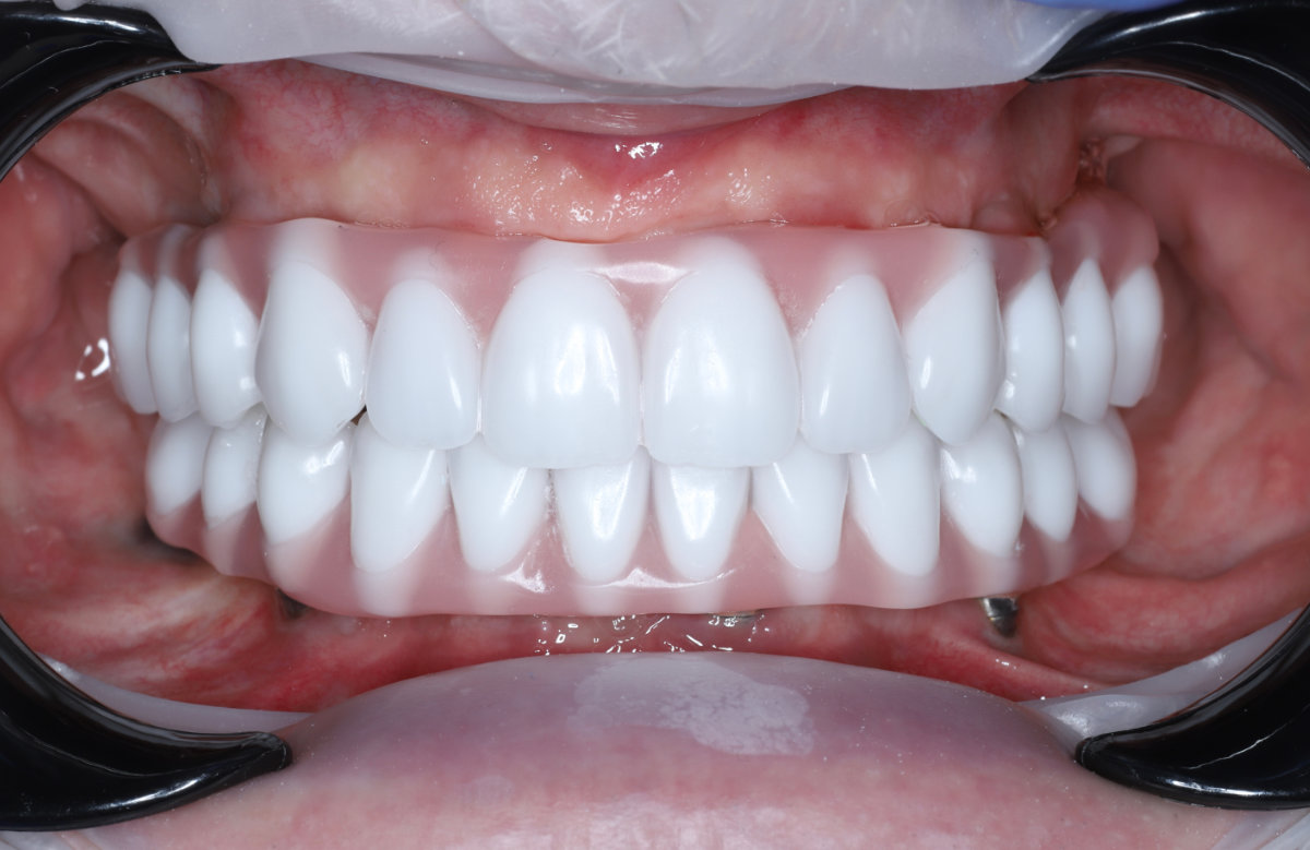 06_All on 4/6/8 frézovaná titánová priečka, kompozitné zuby