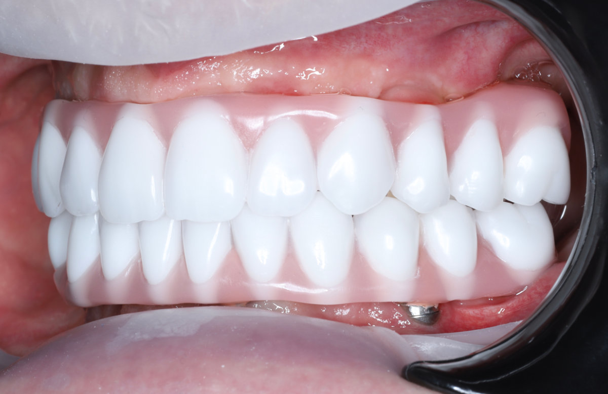 07_All on 4/6/8 frézovaná titánová priečka, kompozitné zuby