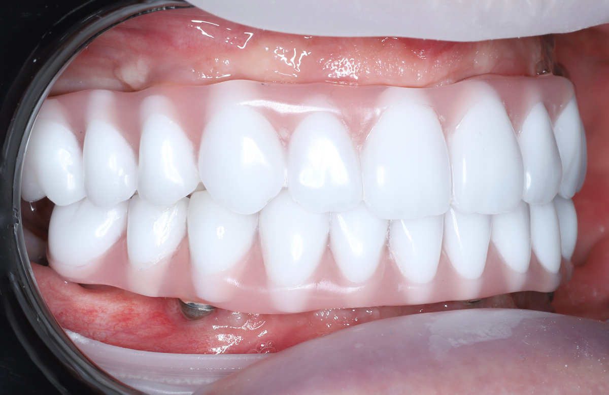 08_All on 4/6/8 frézovaná titánová priečka, kompozitné zuby