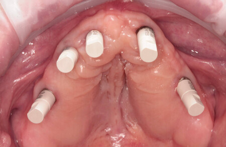 02_All on 4/6 celozirkonova konštrukcia