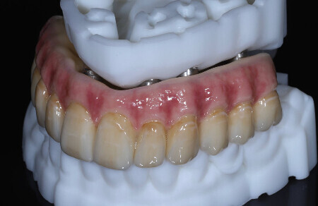 03_All on 4/6 celozirkonova konštrukcia