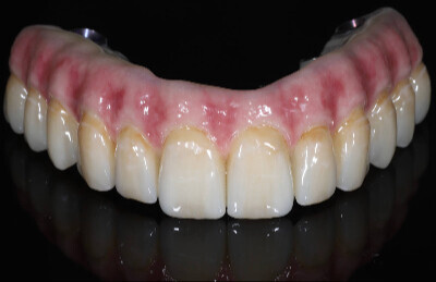 04_All on 4/6 celozirkonova konštrukcia