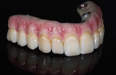 05_All on 4/6 celozirkonova konštrukcia