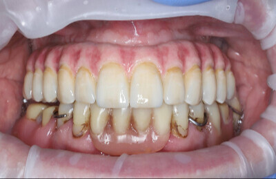 07_All on 4/6 celozirkonova konštrukcia