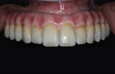 08_All on 4/6 celozirkonova konštrukcia