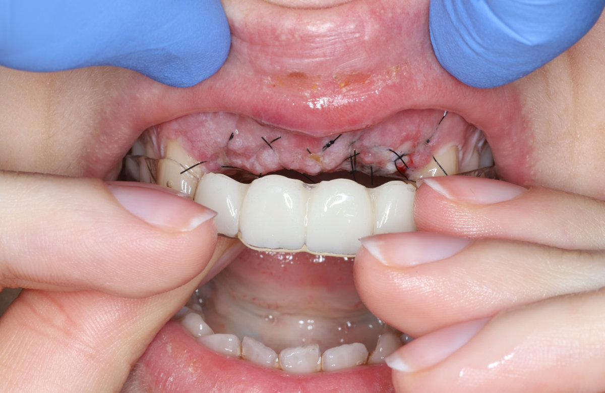 02_Dočasné riešenie pomocou priesvitnej fólie po augmentácii kosti