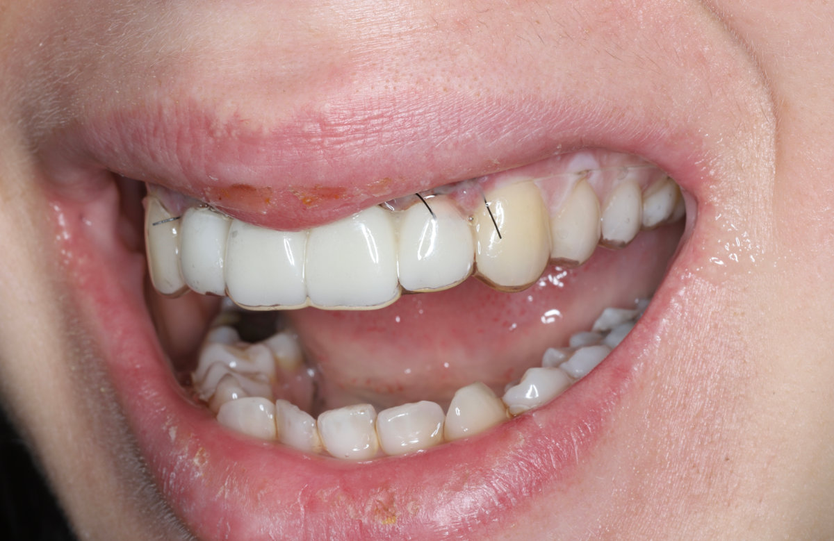 03_Dočasné riešenie pomocou priesvitnej fólie po augmentácii kosti