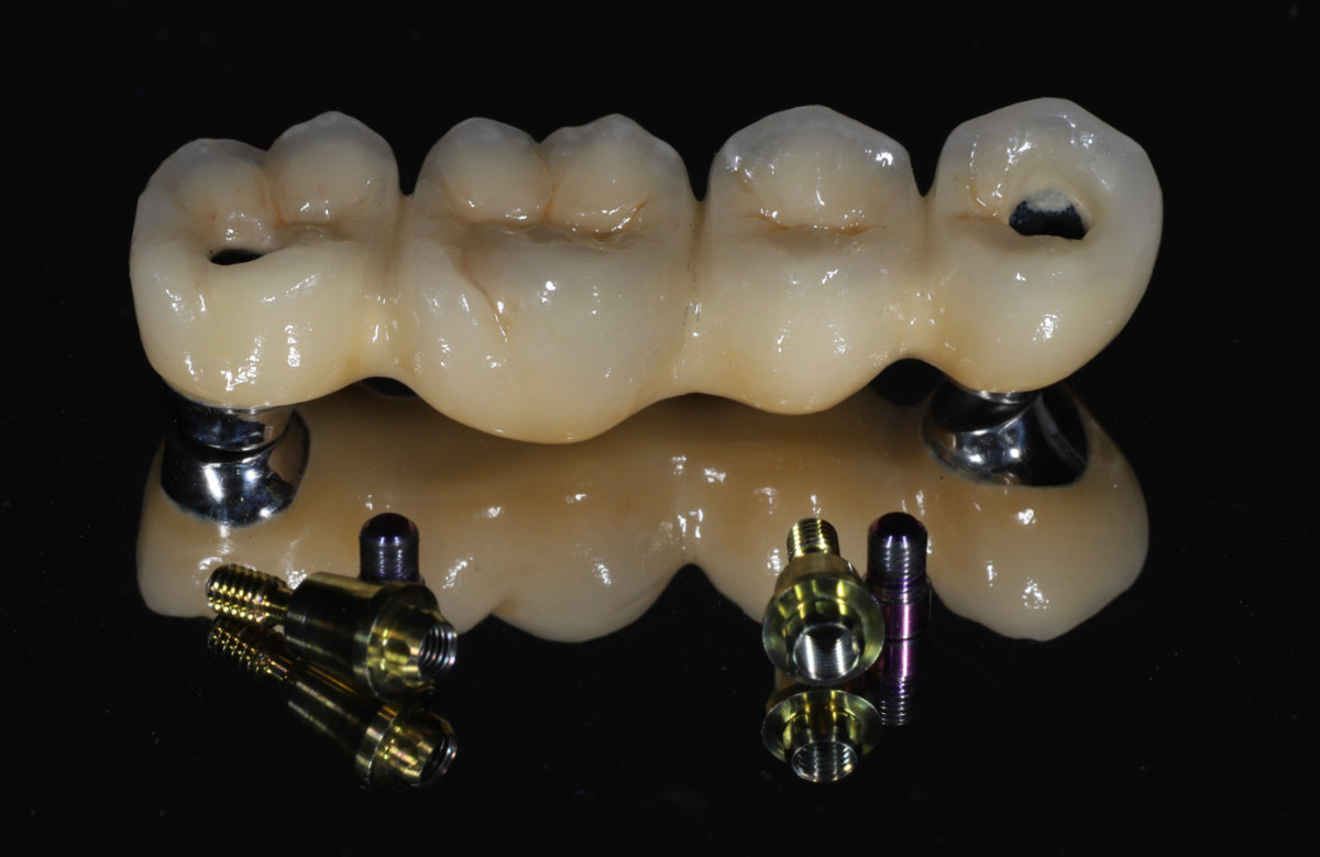 01_Frézovaný kovokeramický mostík s s priamym dosadnutim na multi unit abutment