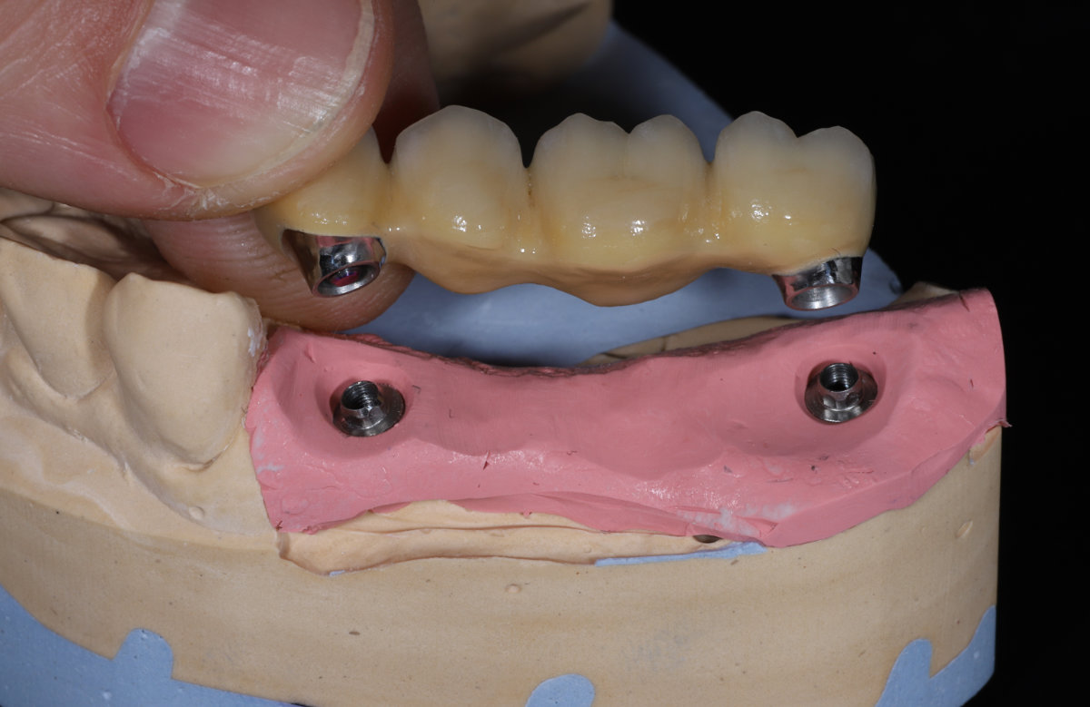 Frézovaný kovokeramický mostík s priamym dosadnutim na multi unit abutment