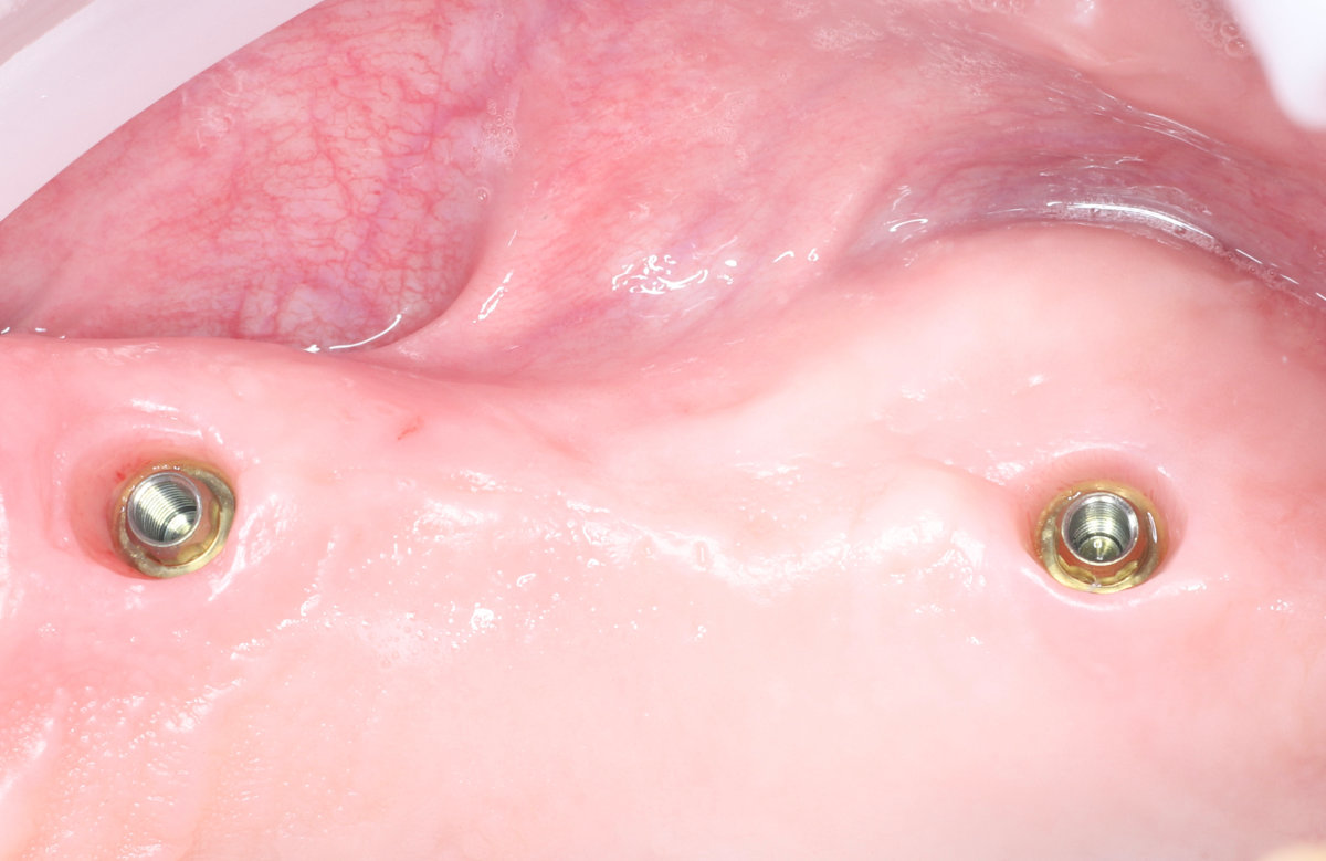 03_Frézovaný kovokeramický mostík s s priamym dosadnutim na multi unit abutment