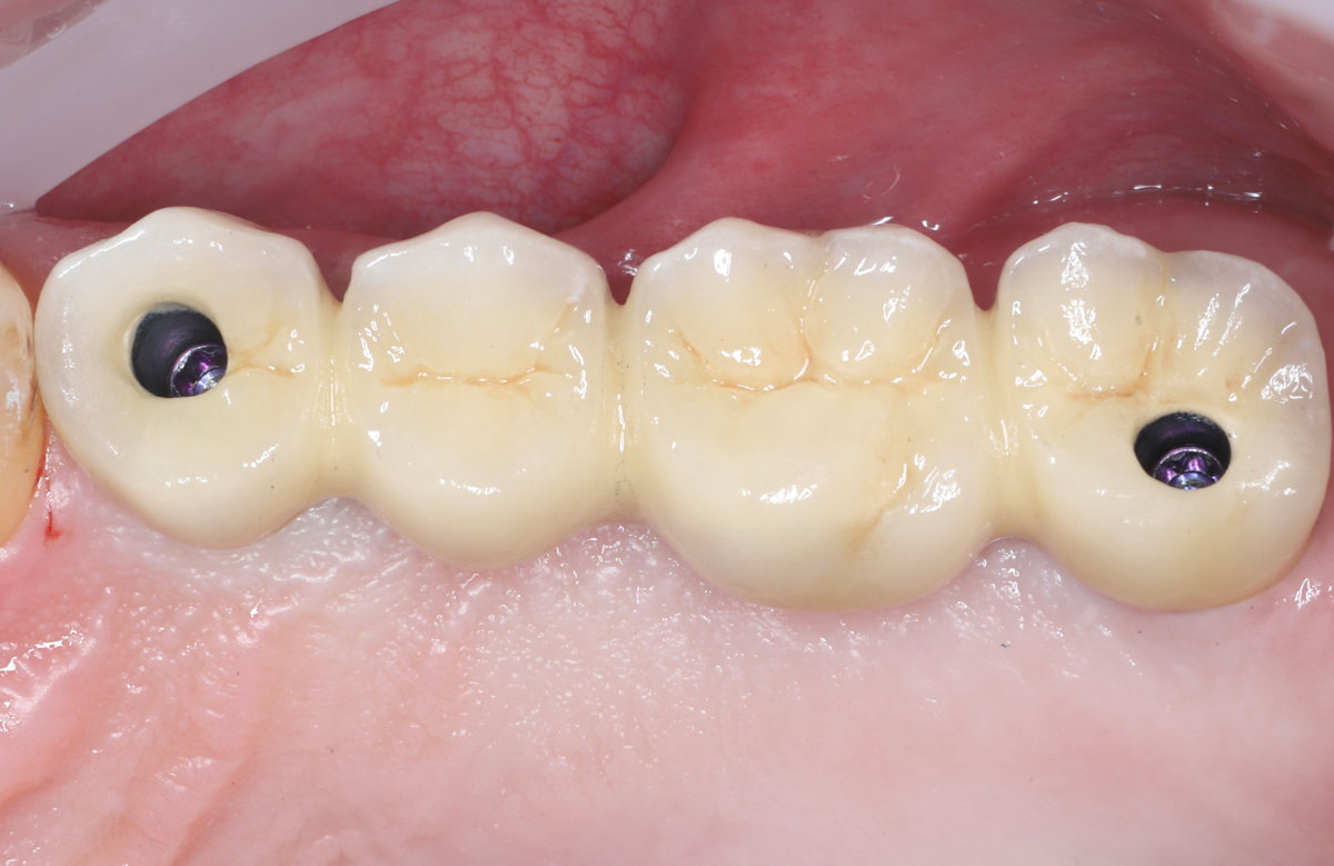 04_Frézovaný kovokeramický mostík s s priamym dosadnutim na multi unit abutment