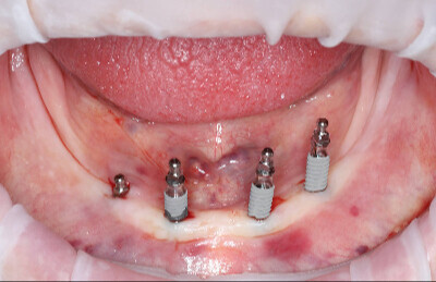 01_Gulickovy systém mini implantáty