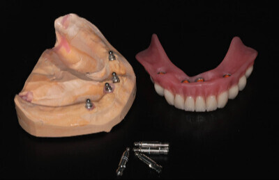03_Gulickovy systém mini implantáty