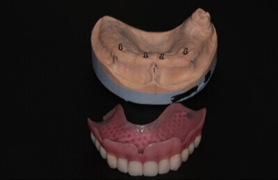 01_Gulickovy_system_mini_implantaty_2