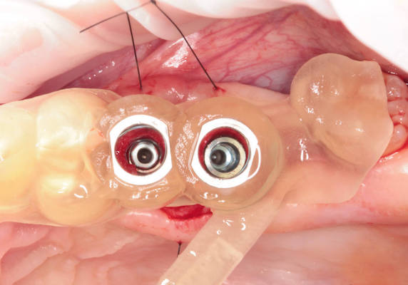 Navigovaná chirurgia, 2 implantátov
