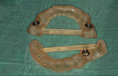 01 Navigovaná chirurgia, 3 implantátov