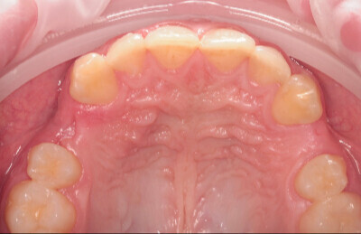 02 Navigovaná chirurgia, 3 implantátov
