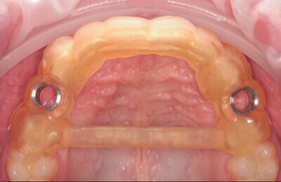 03 Navigovaná chirurgia, 3 implantátov