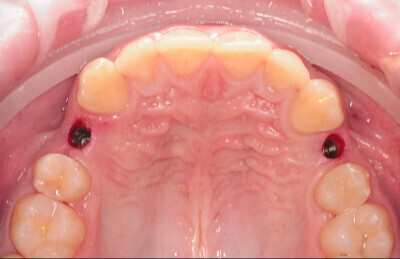 04 Navigovaná chirurgia, 3 implantátov