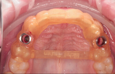 05 Navigovaná chirurgia, 3 implantátov