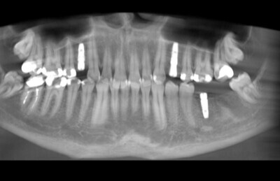07 Navigovaná chirurgia, 3 implantátov