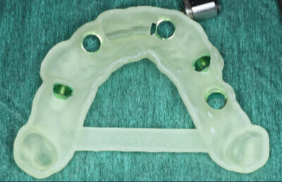 01 Navigovaná chirurgia, 5 implantátov