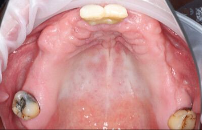 02 Navigovaná chirurgia, 5 implantátov
