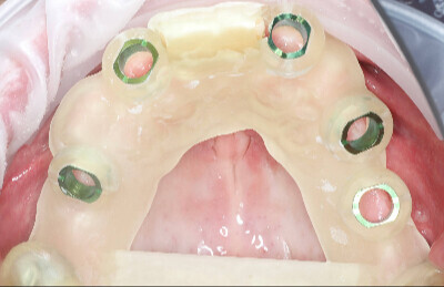 03 Navigovaná chirurgia, 5 implantátov