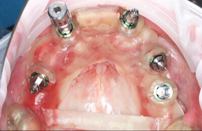04 Navigovaná chirurgia, 5 implantátov