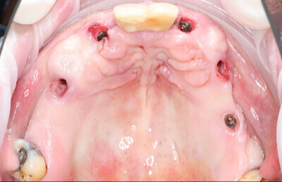 05 Navigovaná chirurgia, 5 implantátov