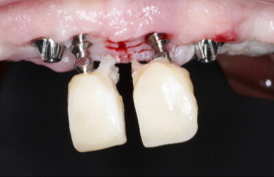 06 Navigovaná chirurgia, 5 implantátov