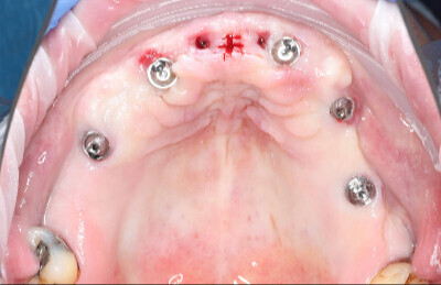 07 Navigovaná chirurgia, 5 implantátov