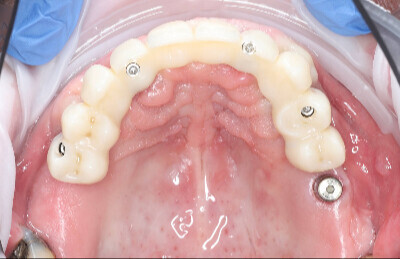 09 Navigovaná chirurgia, 5 implantátov