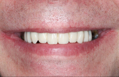 10 Navigovaná chirurgia, 5 implantátov