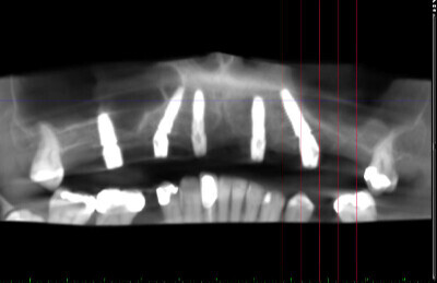 11 Navigovaná chirurgia, 5 implantátov