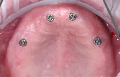 02 Snímateľné náhrady na lokátoroch